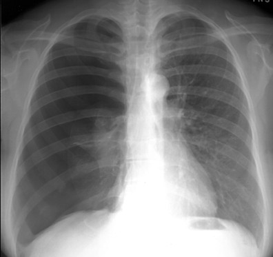 рентгеноанатомия легких