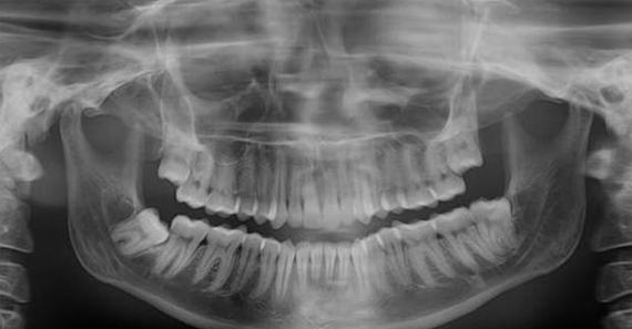 рентгеноанатомия зубов